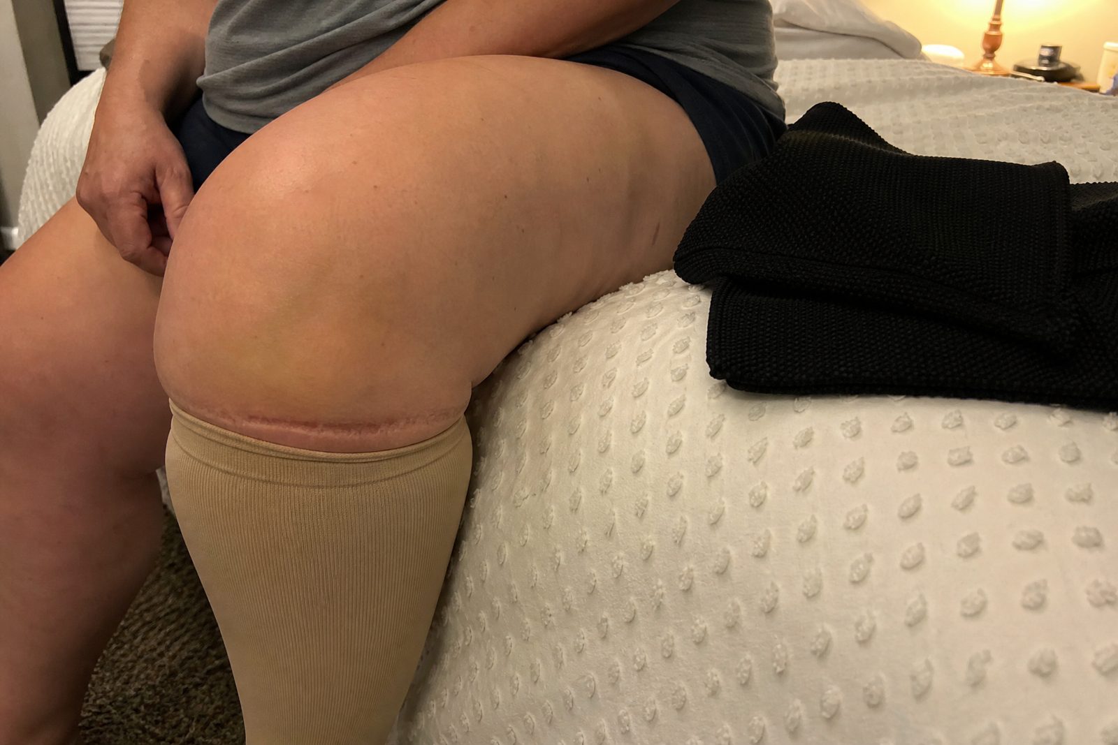 A deep red ring left below the knee by a compression sock band, the sock lying beside her on the bed